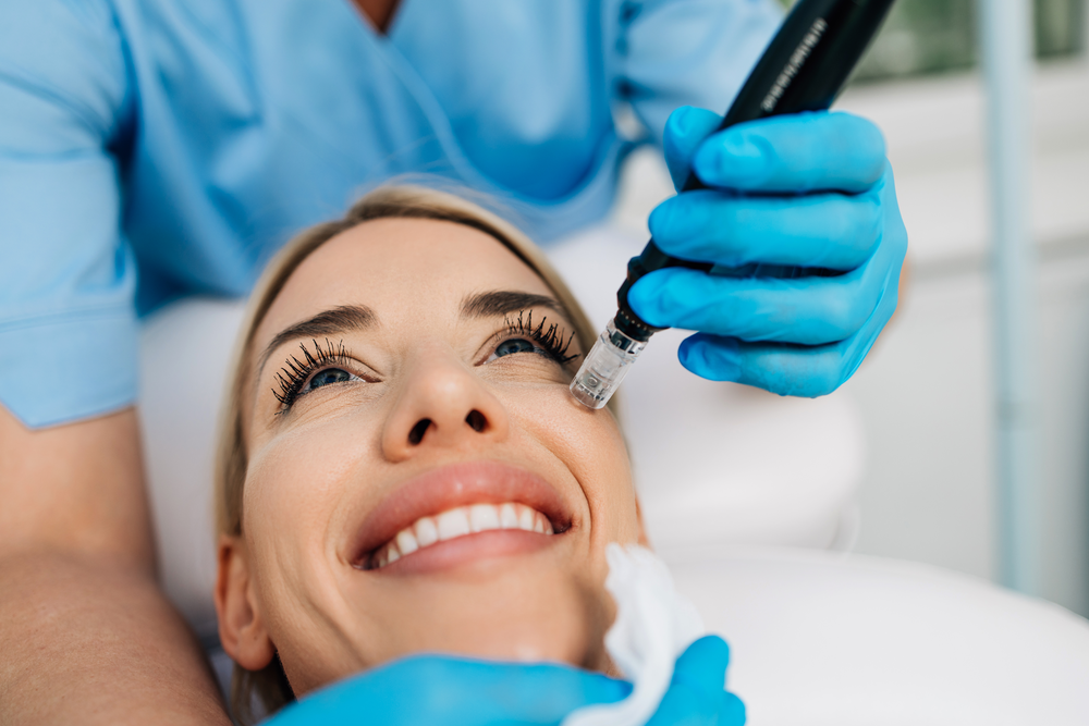 Microneedling PRP facial treatment