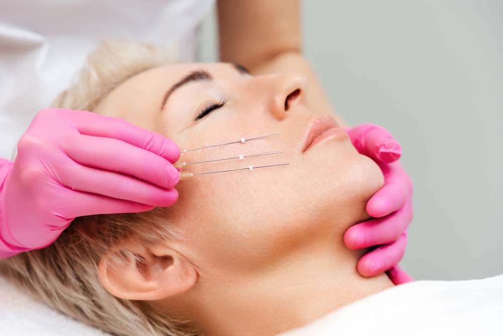 PDO thread treatment at La Vida Aesthetics & Wellness