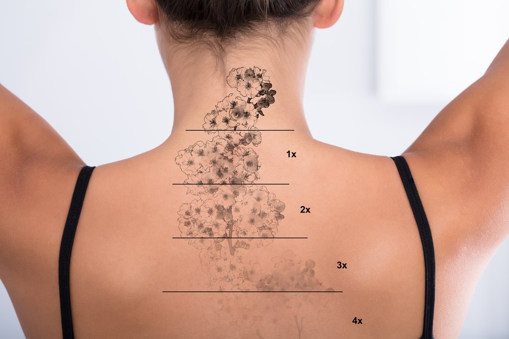 Laser tattoo removal treatment at La Vida